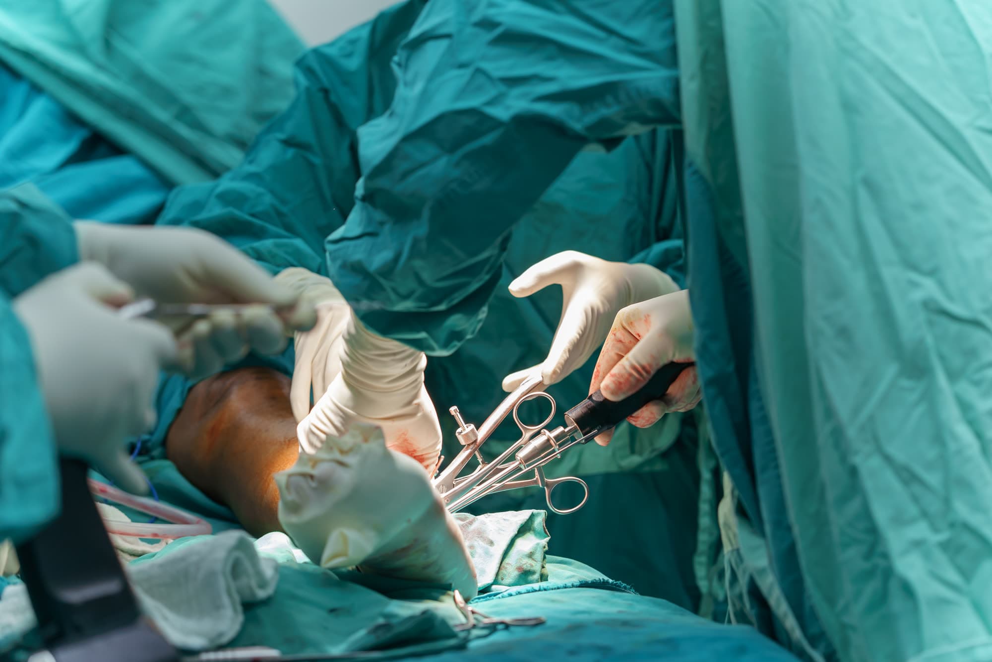 Intervention de chirurgie orthopédique au bloc opératoire
